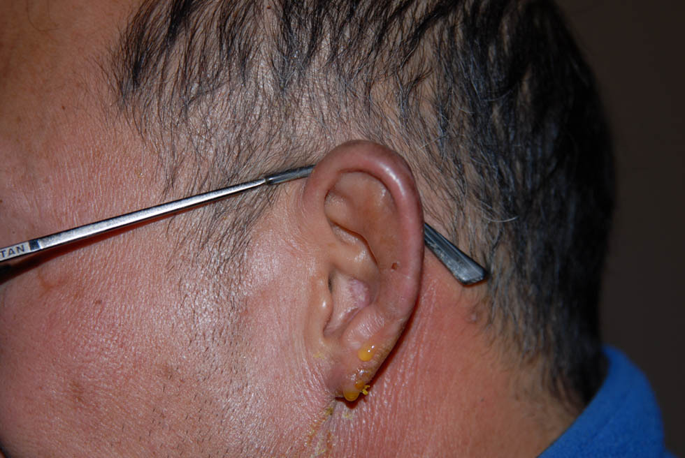 初识五台山 (痛并快乐的经历,被冻伤) - 文章 - 8264户外